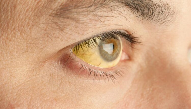 تجاربكم مع اصفرار العين والاسباب وطرق العلاج